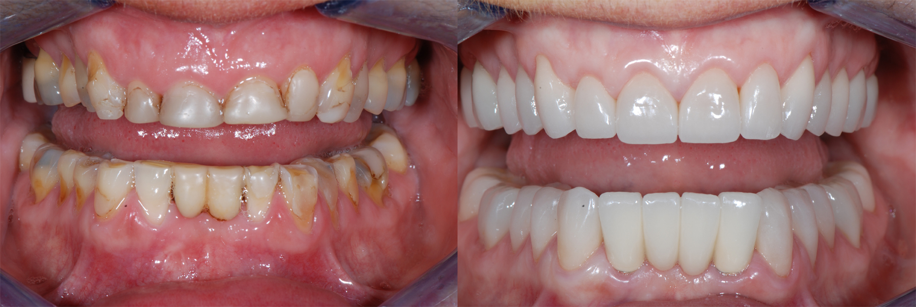Full Mouth Rehabilitation